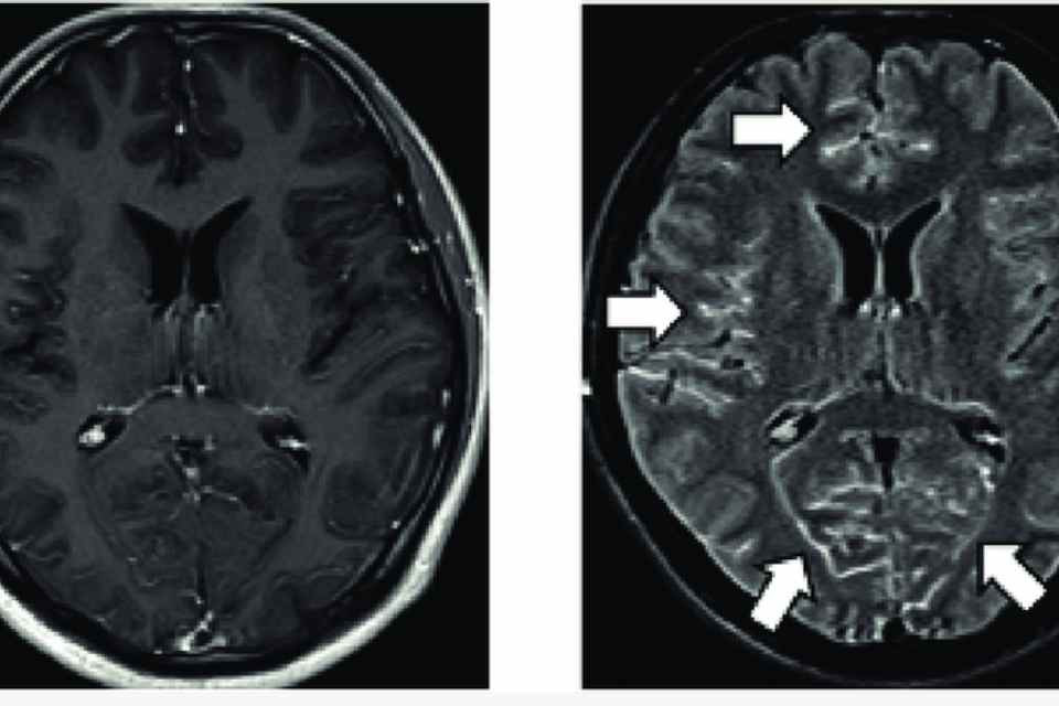 MENINGITIS